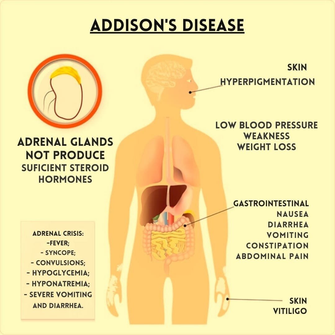 Addison's Disease - FreshVitals