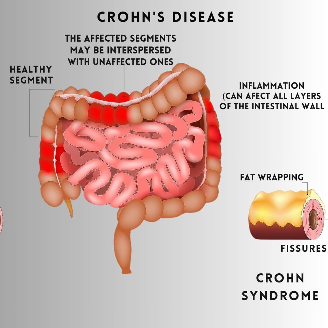 Crohn s Disease FreshVitals